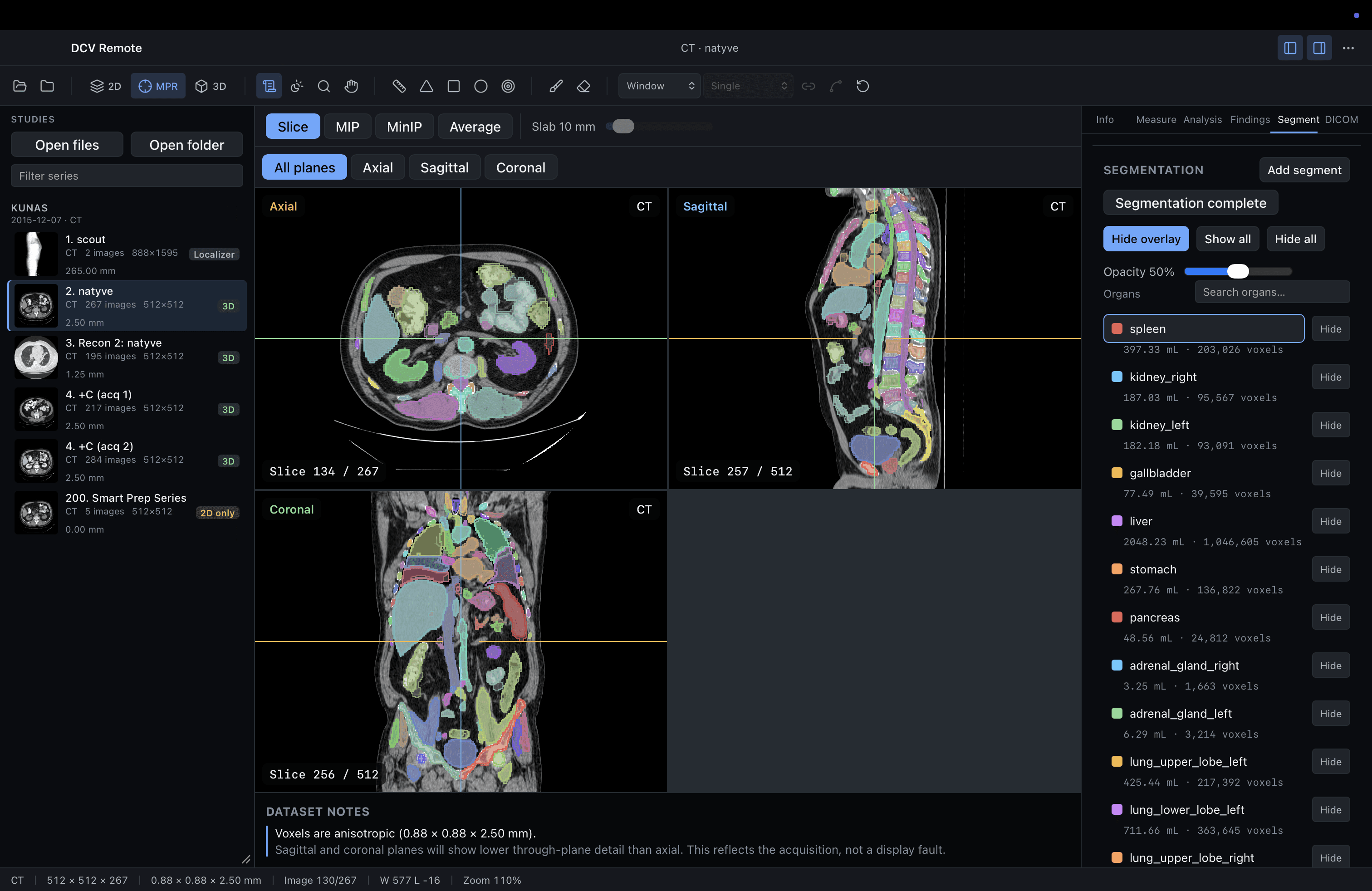 Cross-platform DICOM viewer showing axial, sagittal, and coronal CT views with AI-assisted organ segmentation